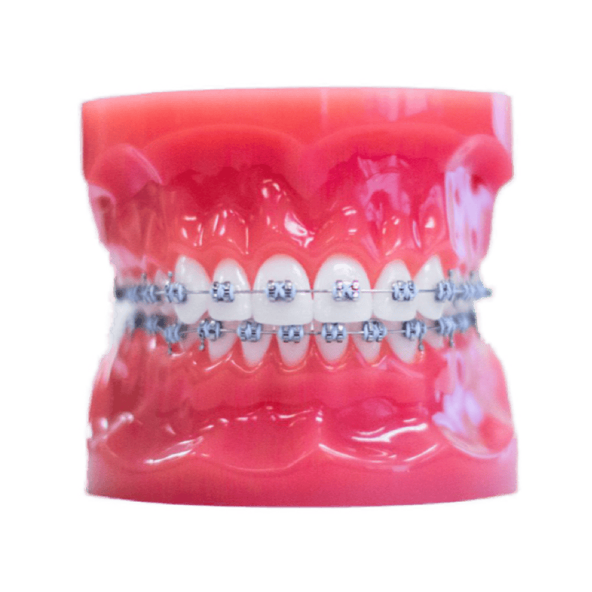 metal braces