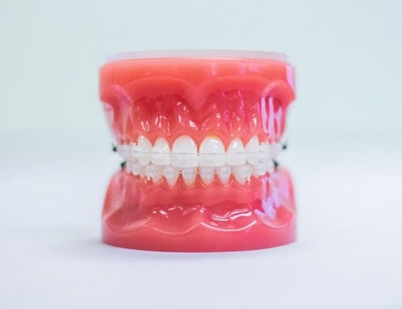 Clear ceramic braces option for Portland patients seeking discreet orthodontic treatment