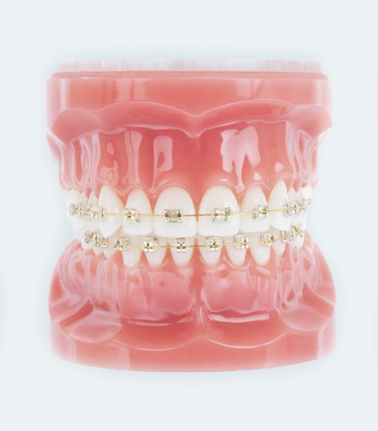 Champagne gold Iconix braces on dental model available at Dr. Matt Orthodontics in Beaverton