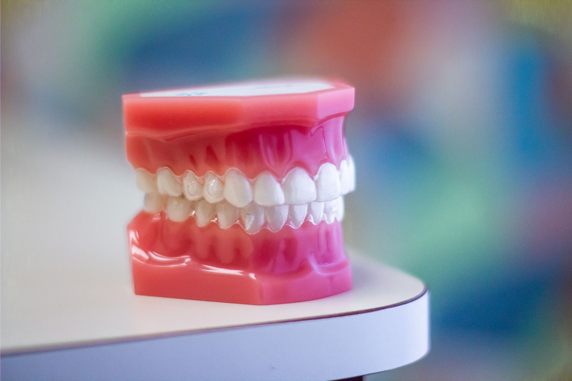 Dental model fitted with a clear aligner tray, showing how the removable trays sit over the teeth
