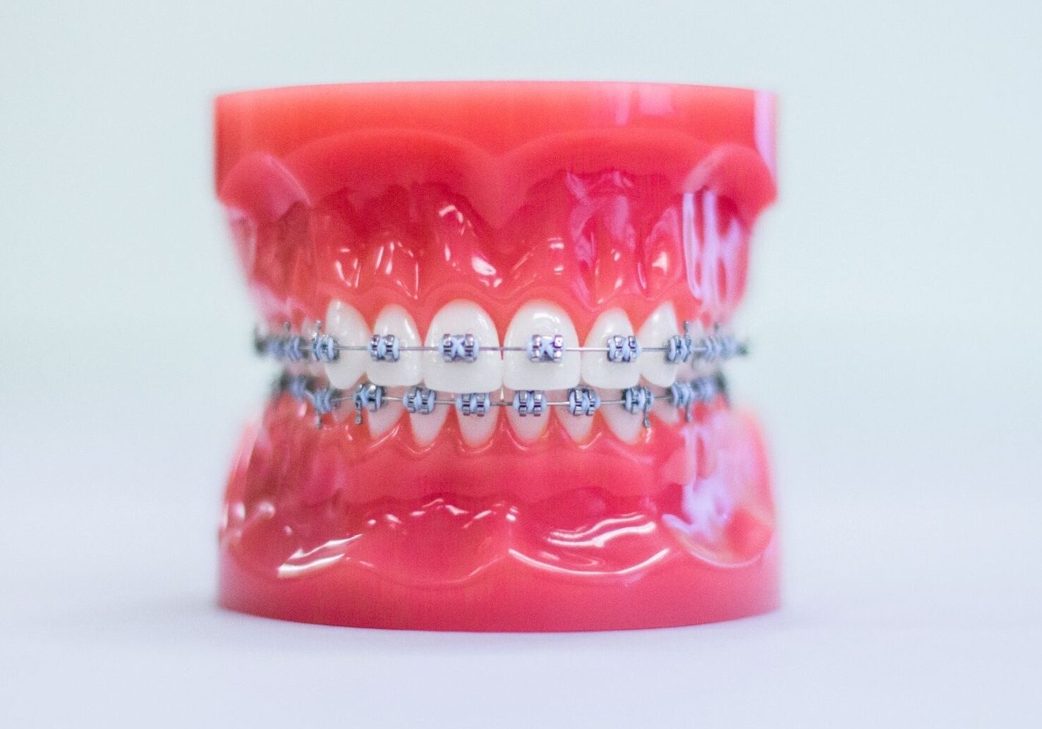 metal braces